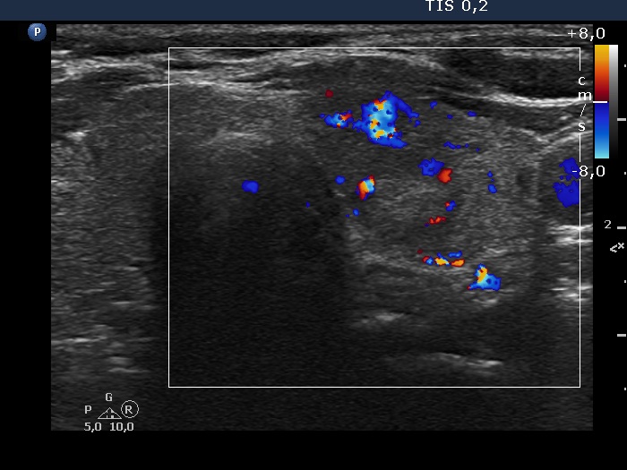 Right lobe, longitudinal scan