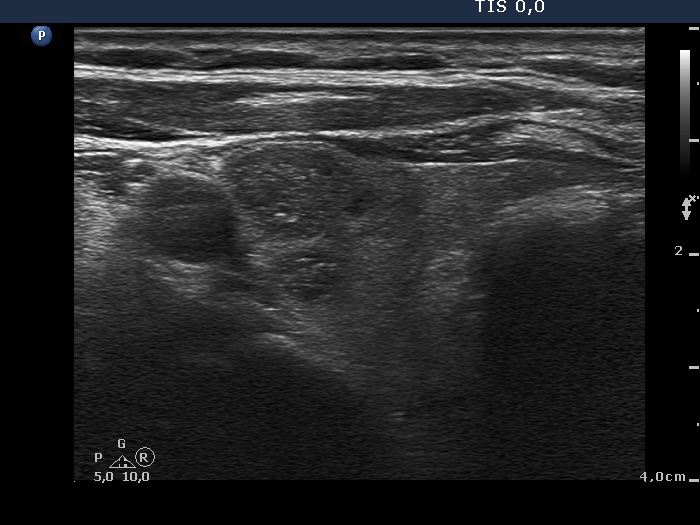 Right lobe, longitudinal scan
