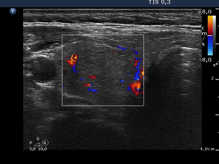 Right lobe, longitudinal scan