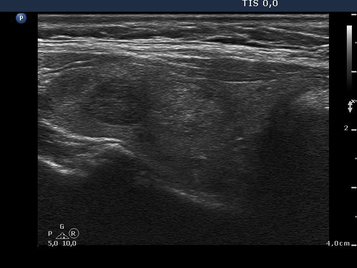 Right lobe, longitudinal scan
