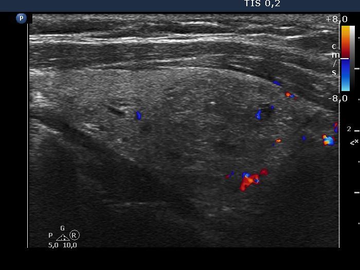 Right lobe, longitudinal scan