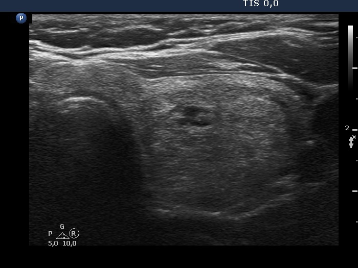 Right lobe, longitudinal scan