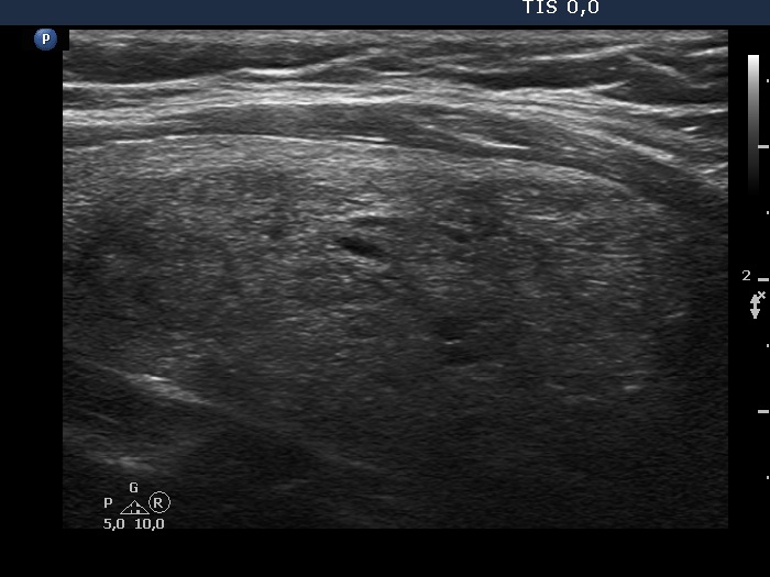 Right lobe, longitudinal scan