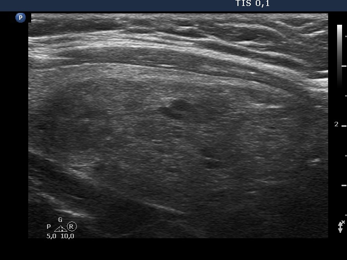 Right lobe, longitudinal scan