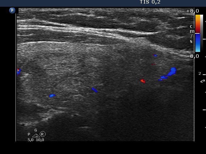 Right lobe, longitudinal scan