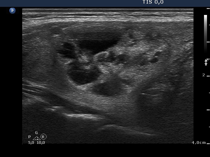 Right lobe, longitudinal scan