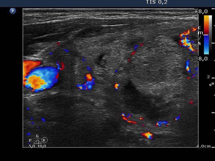 Right lobe, longitudinal scan