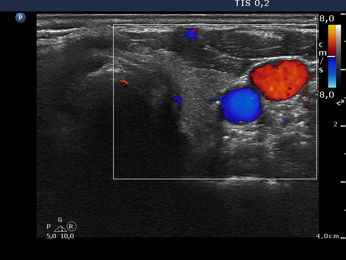 Right lobe, longitudinal scan