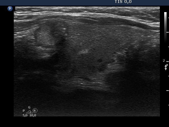 Right lobe, longitudinal scan