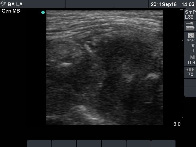 Right lobe, longitudinal scan