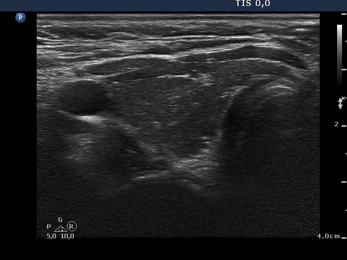 Right lobe, horizontal view