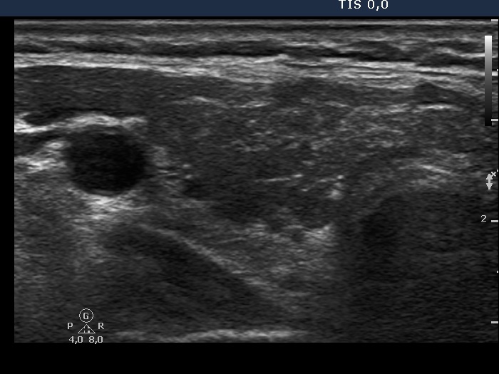 Right lobe, horizontal view