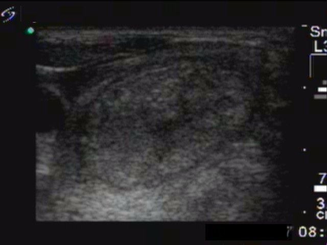 Right lobe, longitudinal scan