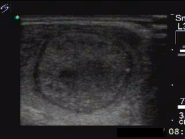 Right lobe, longitudinal scan