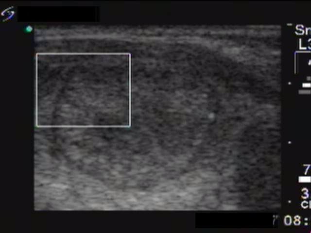 Right lobe, longitudinal scan