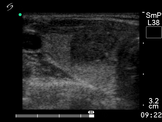 Right lobe, longitudinal scan