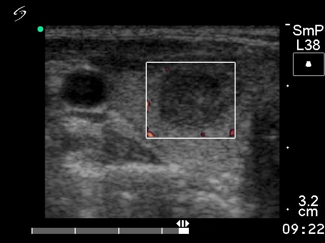Right lobe, longitudinal scan