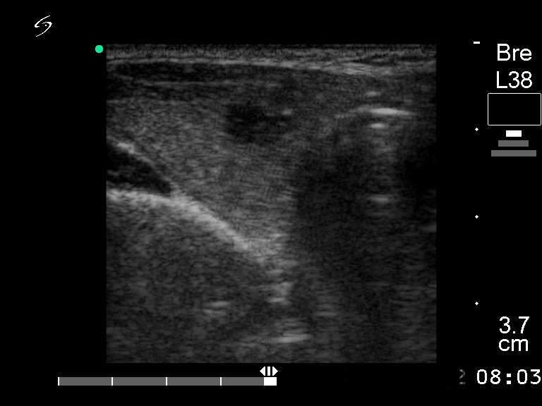 Right lobe, longitudinal scan
