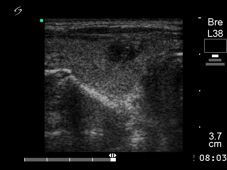 Right lobe, longitudinal scan
