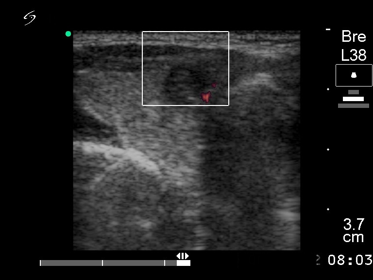 Right lobe, longitudinal scan