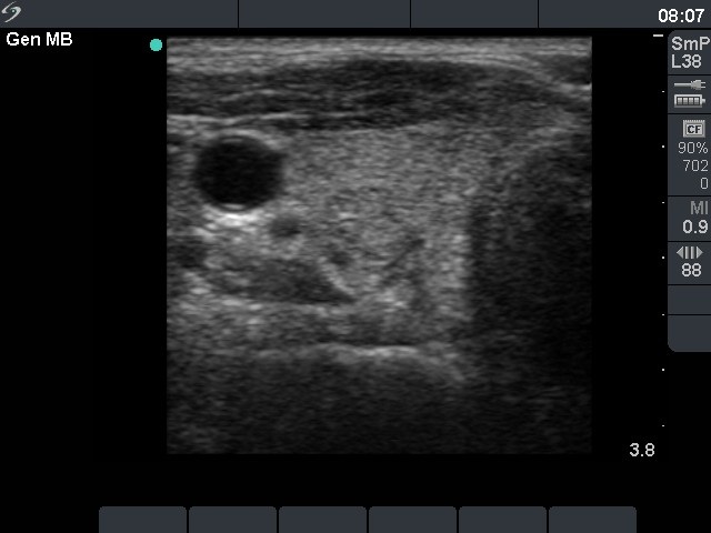 Right lobe, longitudinal scan