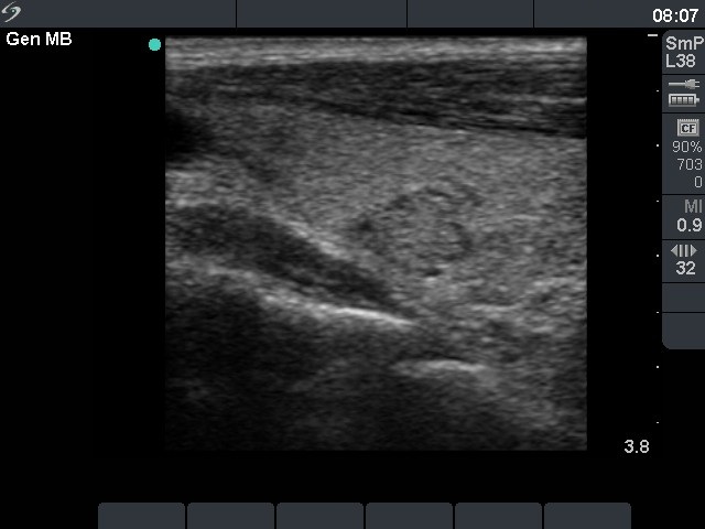 Right lobe, longitudinal scan