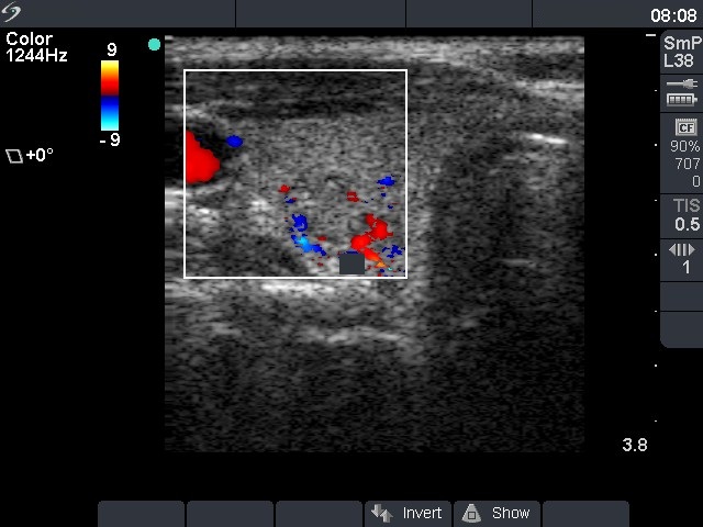 Right lobe, longitudinal scan