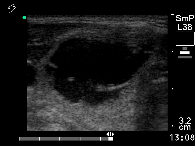 Right lobe, horizontal view