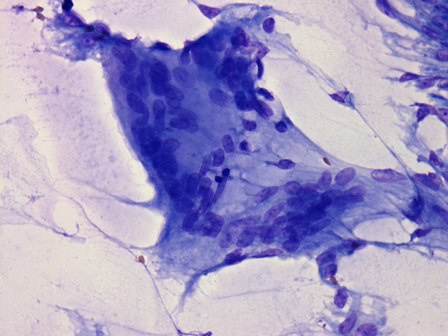 Subacut granulamatosus (De Quervain’s) thyreoiditis | Eurocytology
