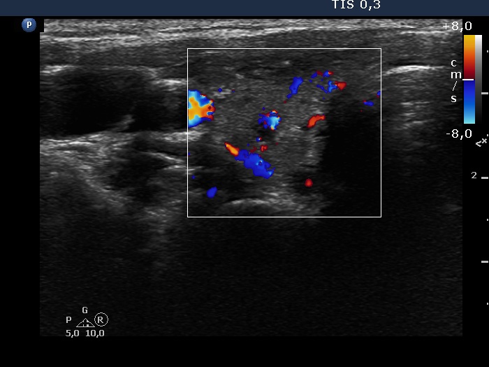 Right lobe, longitudinal scan