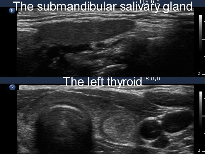 Right lobe, longitudinal scan
