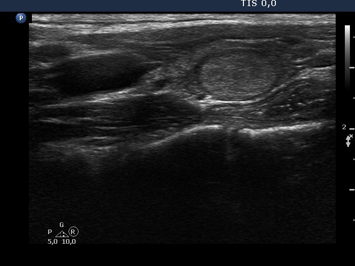Right lobe, longitudinal scan