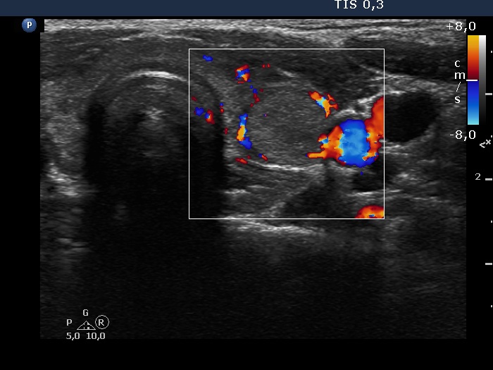 Right lobe, longitudinal scan