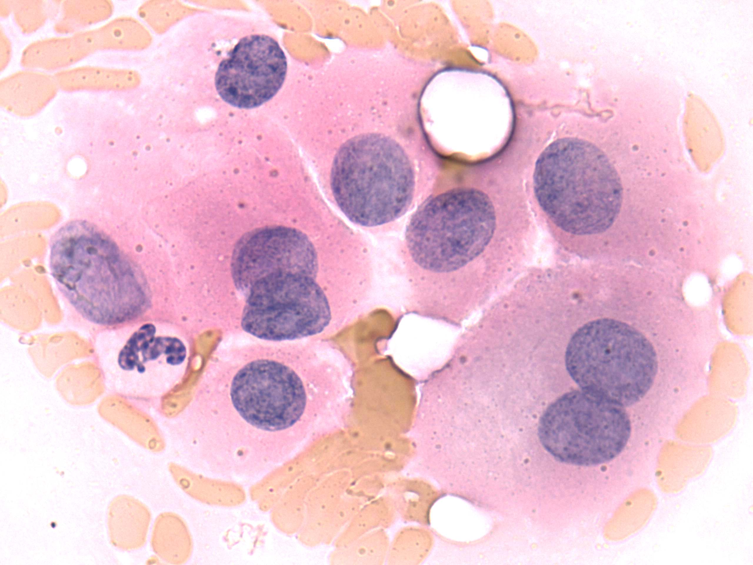 hurthle cell metaplasia Gallery