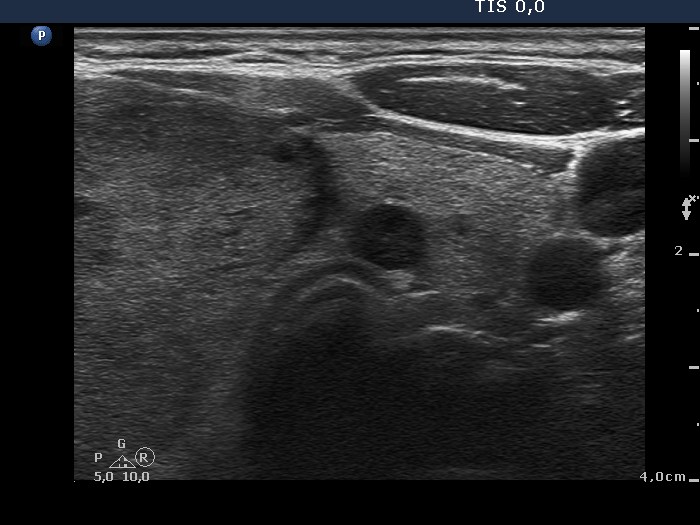 Right lobe, longitudinal scan
