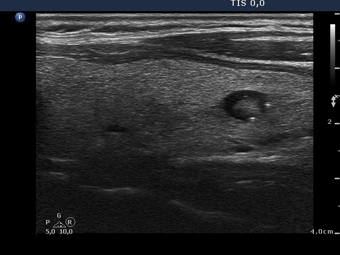 Right lobe, longitudinal scan
