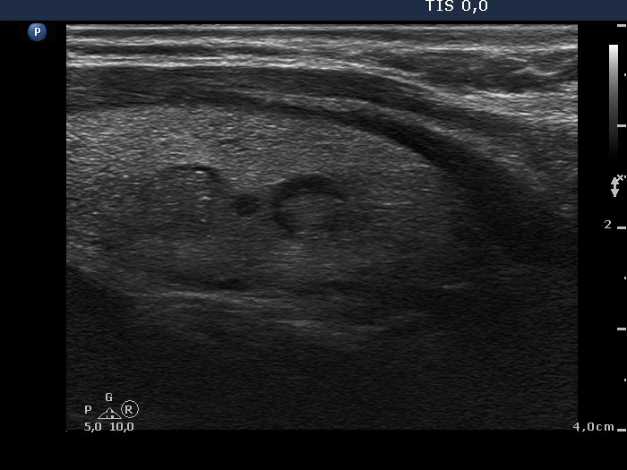 Right lobe, longitudinal scan