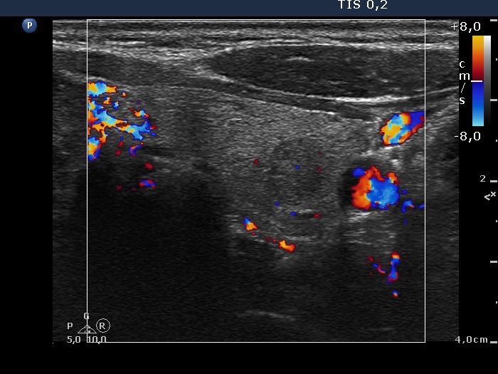 Right lobe, longitudinal scan