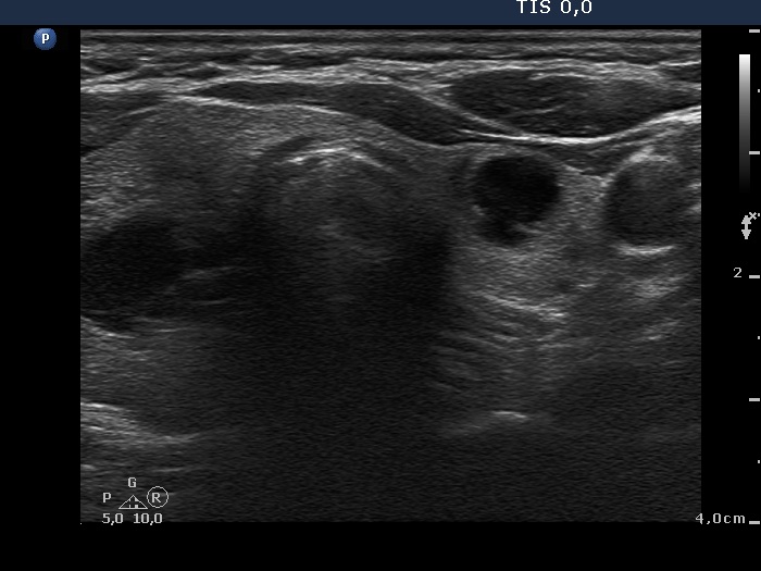 Right lobe, longitudinal scan