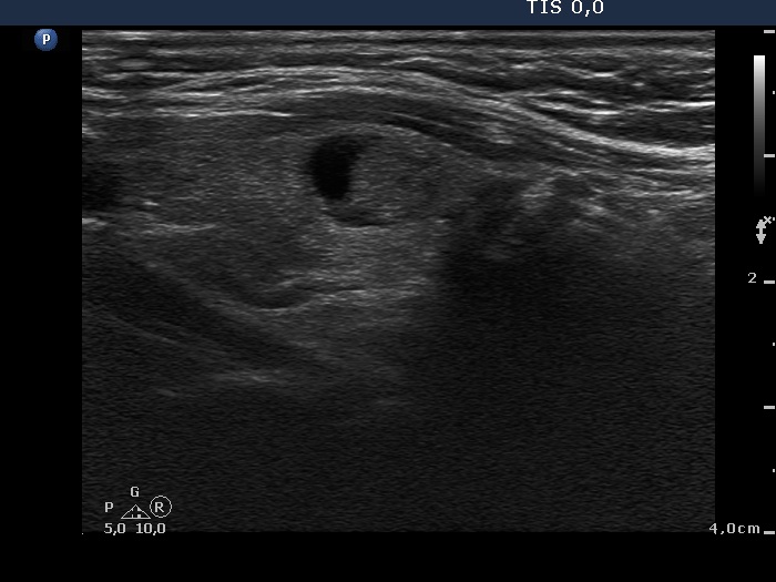 Right lobe, longitudinal scan