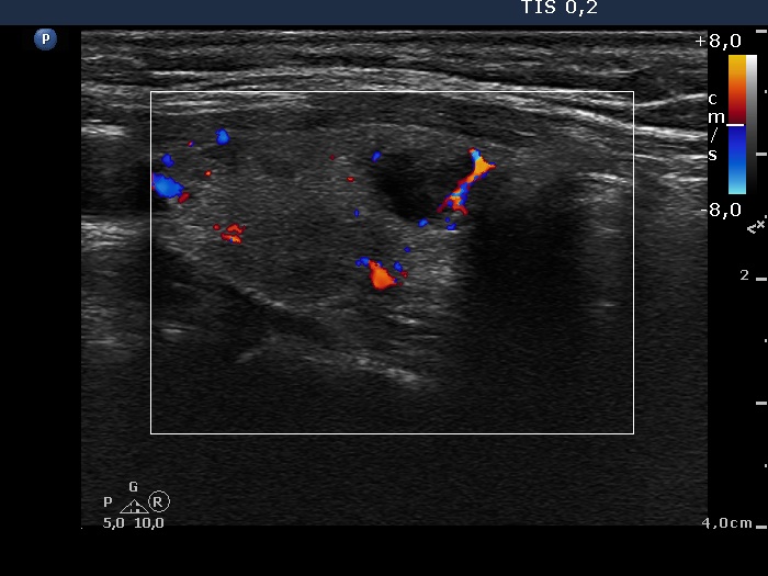 Right lobe, longitudinal scan