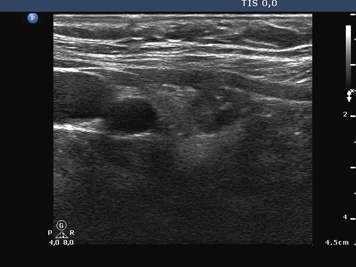 Right lobe, longitudinal scan