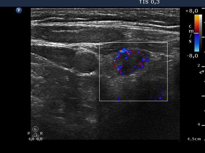 Right lobe, longitudinal scan